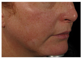 Why is my skin so red-Beauty Salon Matamata - Gloss Beauty Boutique 07 888 9960
