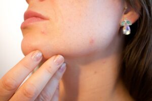Hidden Causes Of Acne